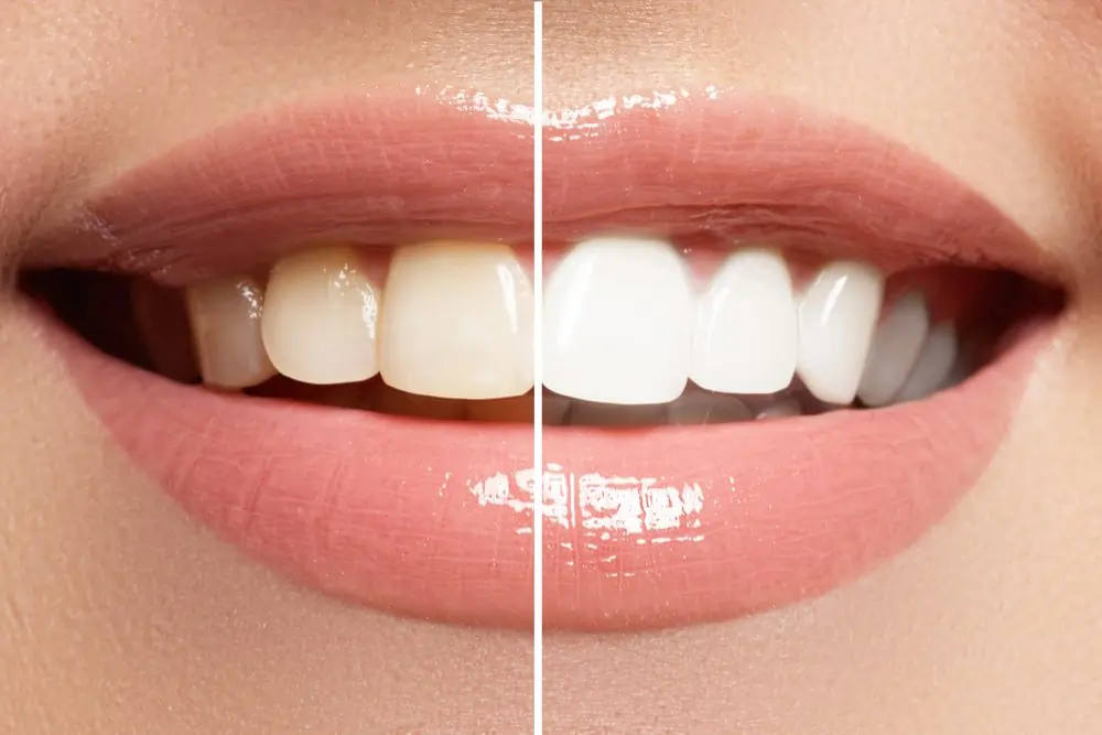 A smiling person showing off their freshly whitened teeth after a lazer treatment Borehamwood