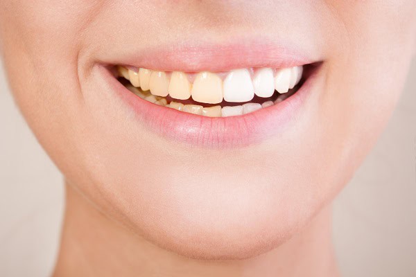 Side-by-side comparison of teeth before and after a lazer whitening session. Borehamwood