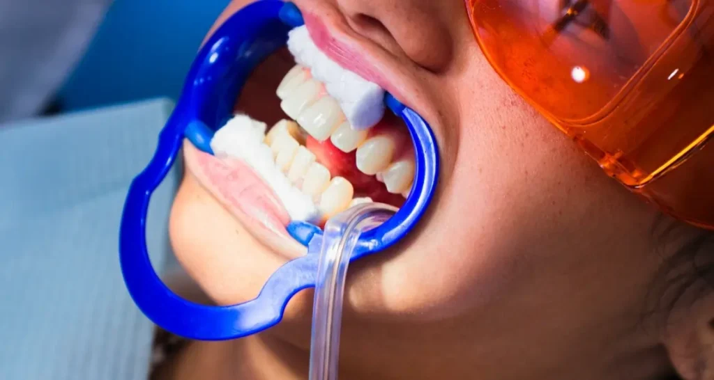 Illustration of teeth with surface-level yellow and brown stains caused by coffee and tobacco Borehamwood