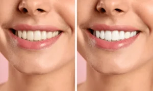 Smiling person undergoing Laser Teeth Whitening for a brighter smile Borehamwood