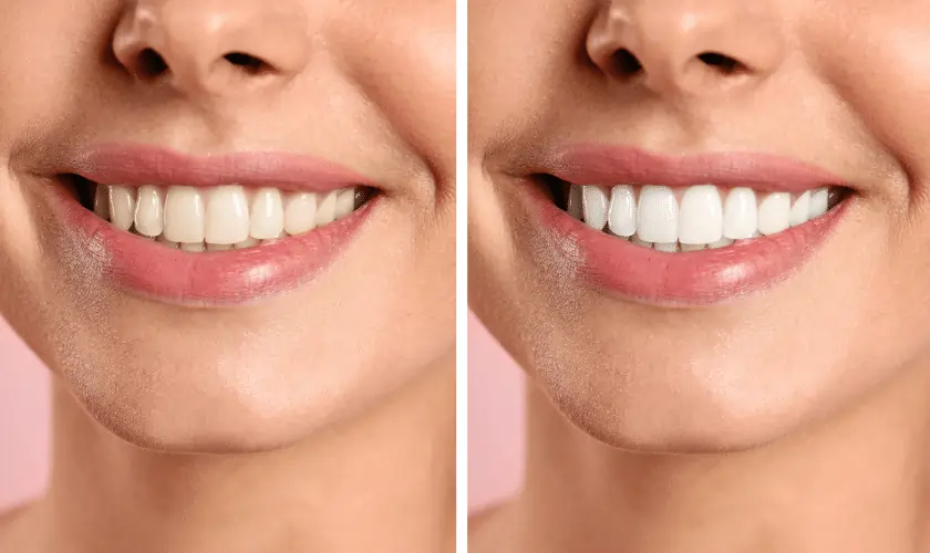 Smiling person undergoing Laser Teeth Whitening for a brighter smile Borehamwood