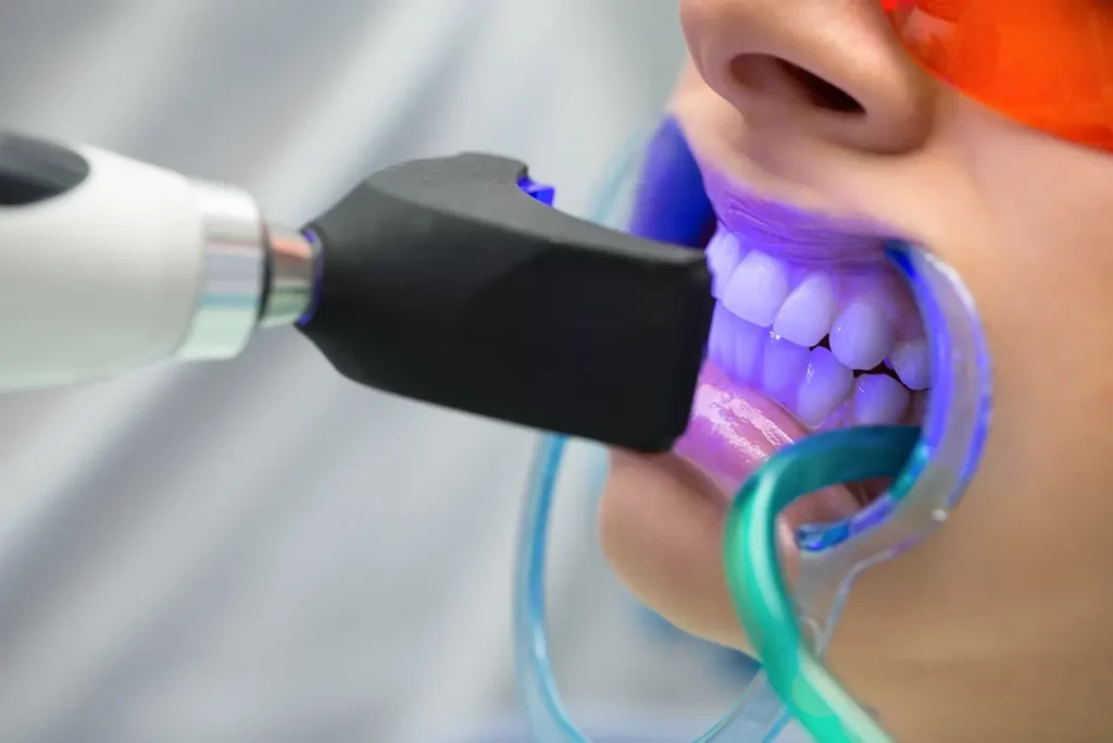 Will I See Immediate Results from Lazer Teeth Whitening Borehamwood